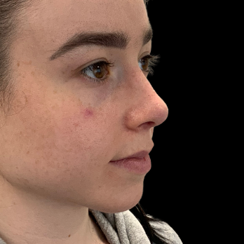 Ultrasonic-rhinoplasty-after